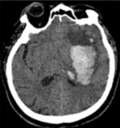 Axial non-contrast head CT with a hemorrhage in the left basal ganglia outlined